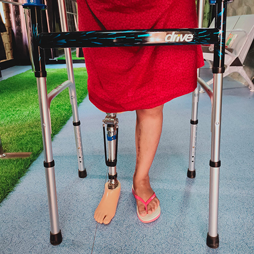 Knee Joint Prosthesis - Color: Natural