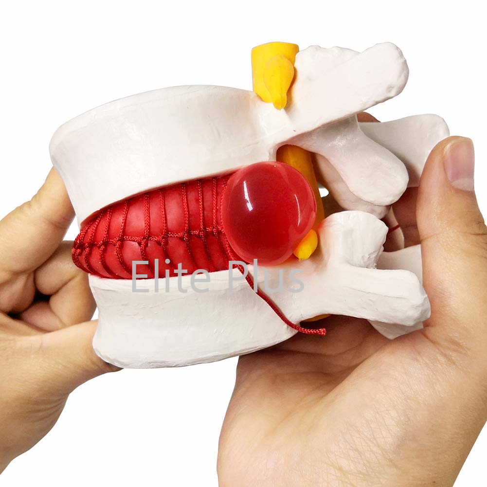 Zx-1504 Functioning Prolapsed Lumbar Vertebrae Model - Color: Ivory