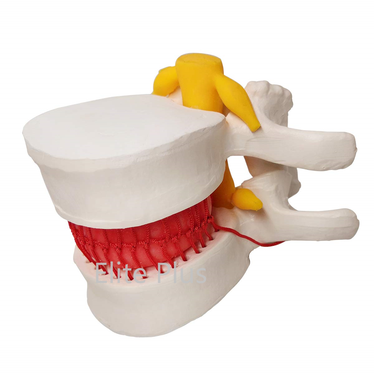 Zx-1504 Functioning Prolapsed Lumbar Vertebrae Model - Color: Ivory