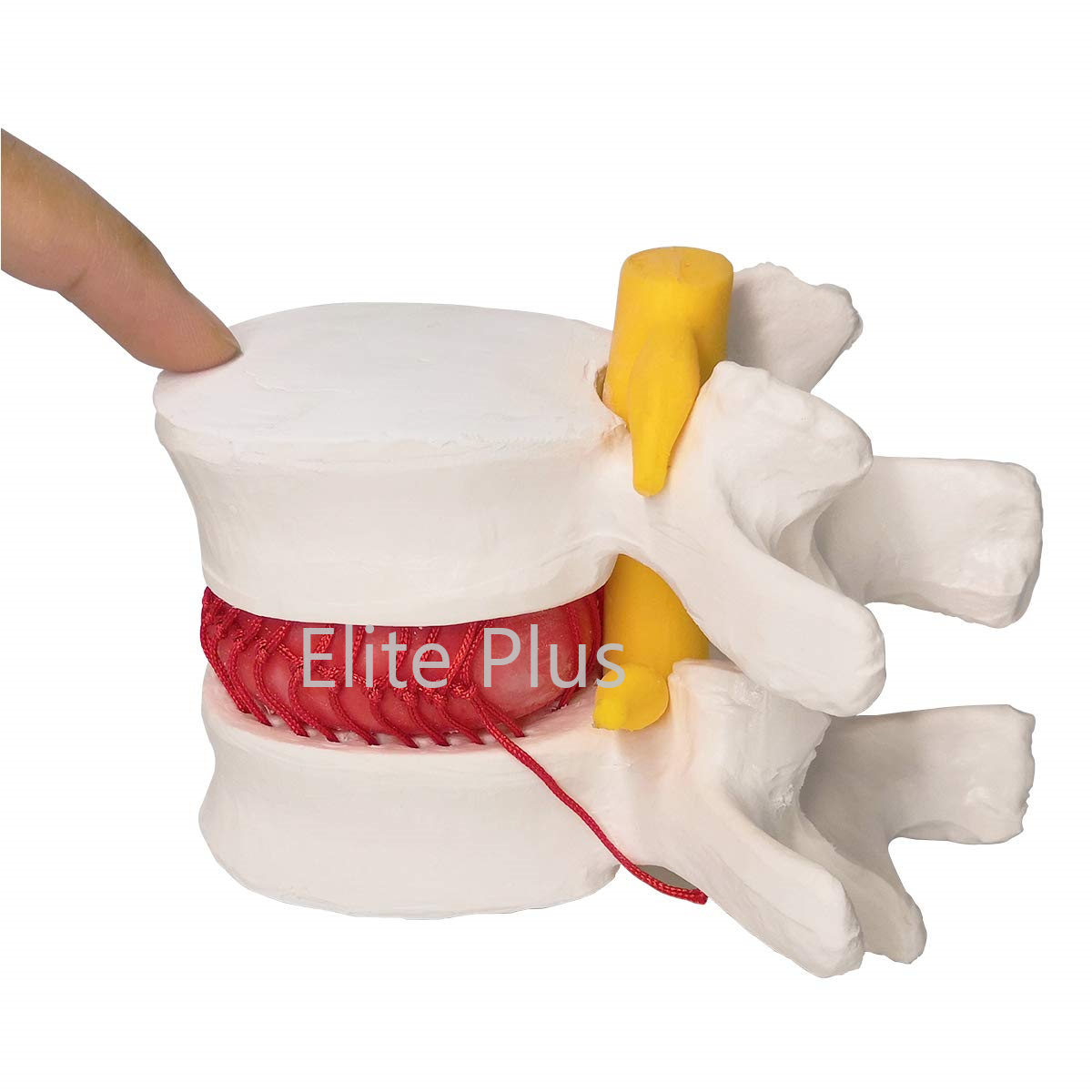 Zx-1504 Functioning Prolapsed Lumbar Vertebrae Model - Color: Ivory
