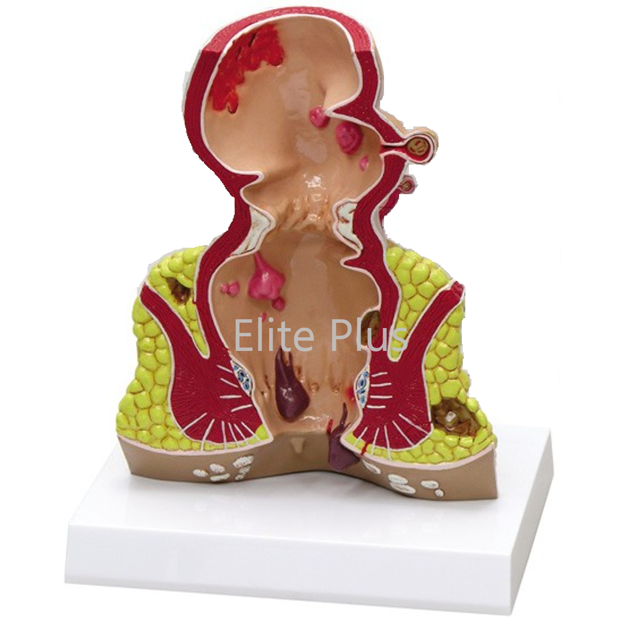 Zx-1514p Rectum Pathologies Model