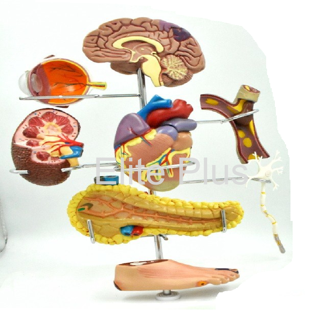 Zx-1511p Diabetes Mellitus Complications Model - Color