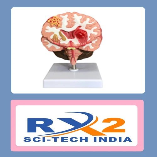 ब्रेन स्ट्रोक मॉडल -