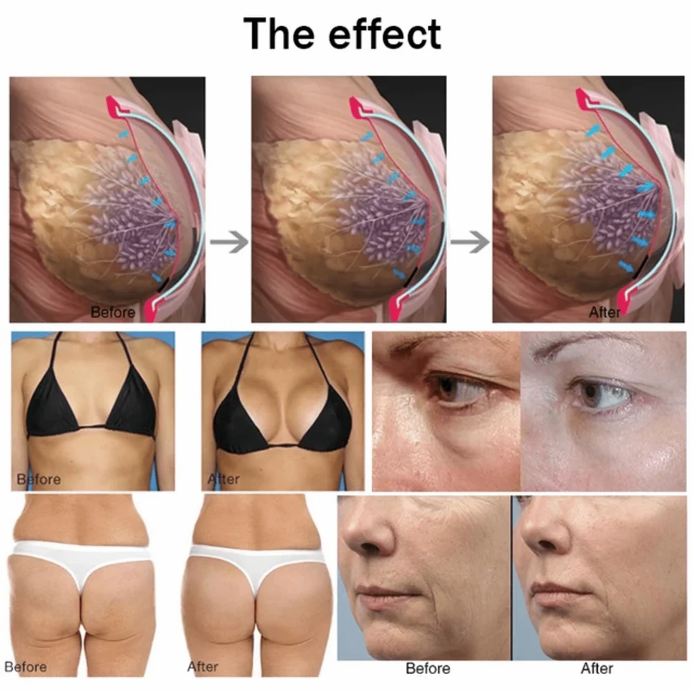 Vacuum Therapy Machine - Plastic, 350w Power, Portable Design | Chest Enhancement, Skin Tightening, And Body Sculpting With 32 Vacuum Cups