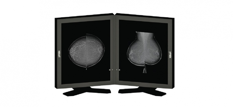 Kiran Felicia Digital Mammography - Automation Grade: Yes