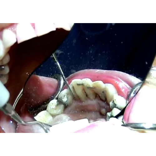 H3 Acteon Initial Periodontics Dental Tips - Color: Silver